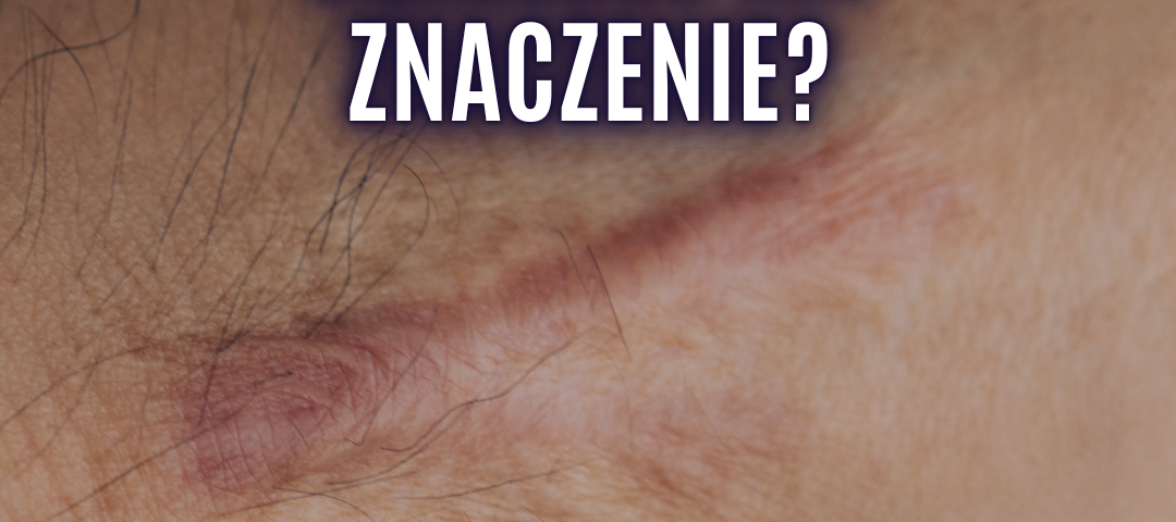 praca z blizną