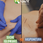 suche igłowanie